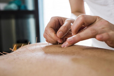 Acupuncture Therapy By Global Pain And Spine Clinic